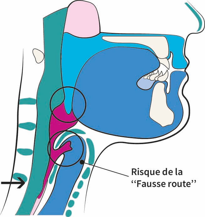 Bascule de lepiglotte