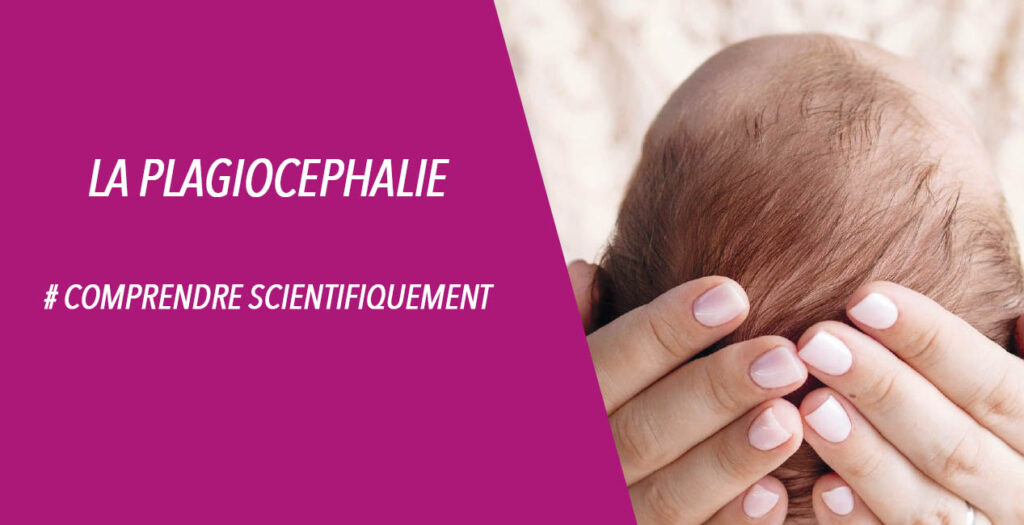 Plagiocéphalie du nourrisson — déformation crânienne positionnelle vue supérieure